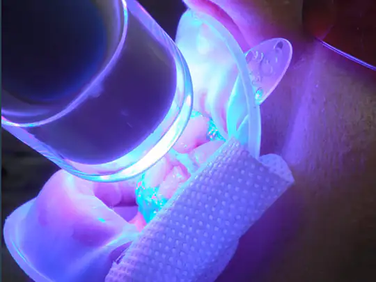 Clareamento dental Profissional sendo executado em consultório, com o controle do dentista. A imagem mostra uma pessoa em close de boca aberta e com afastador labial, recebendo luz ultravioleta com um emissor de led próximo dos dentes.