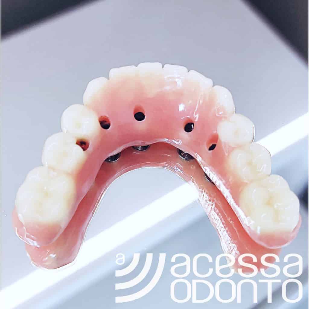 Uma linda prótese protocolo vista por cima sobre uma superfície espelhada, com o logotipo da clínica acessa odontologia