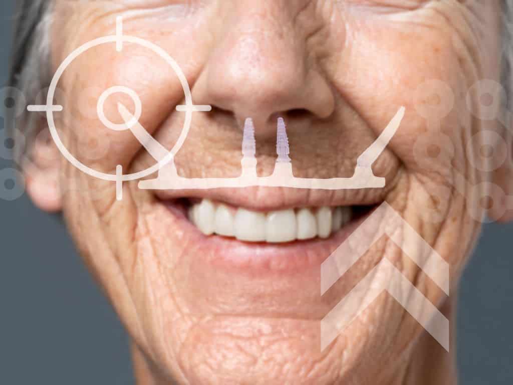 Uma senhora sorrindo com efeitos digitais mostrando o protocolo zigomático que é o realizado na maça do rosto, para fixar uma arcada dentária completa