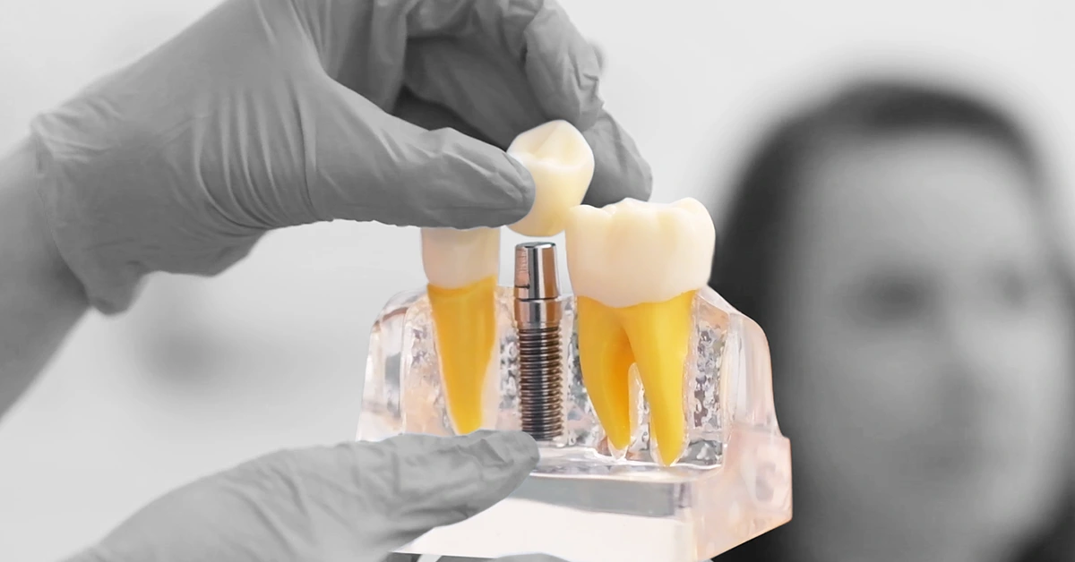 Implantes Dentários em Carga Imediata: Tudo o Que Você Precisa Saber
