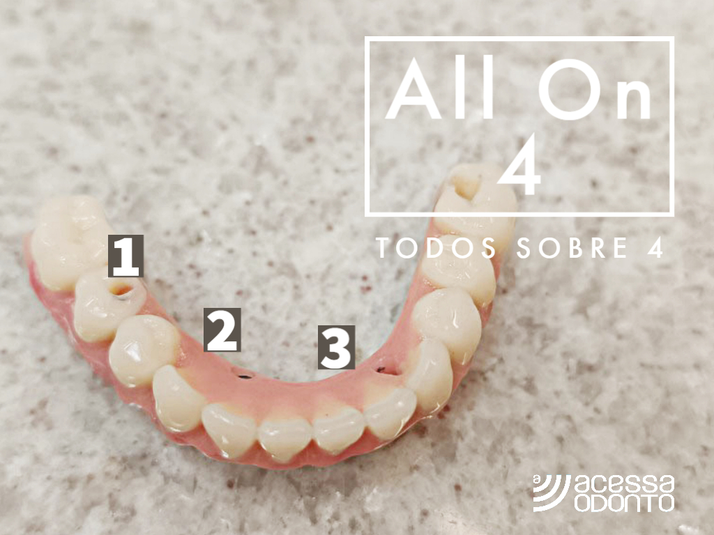 All-On-Four é um tipo de protocolo dentário com 4 implantes