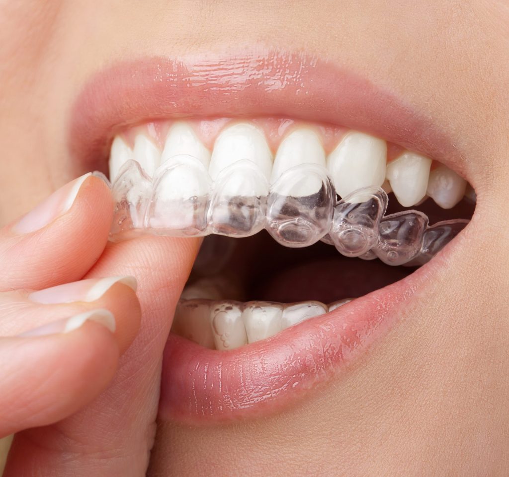 Uma pessoa levando a moldeira com gel clareador à boca, encaixando nos dentes superiores e já com a moldeira de clareamento encaixada nos dentes inferiores.