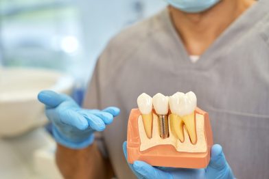 Implante Dentário Rápido