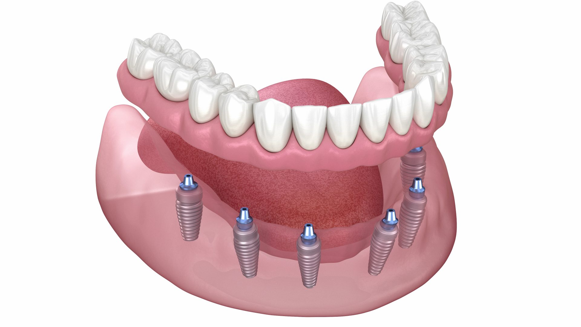 Uma linda prótese protocolo vista por cima sobre uma superfície espelhada, com o logotipo da clínica acessa odontologia